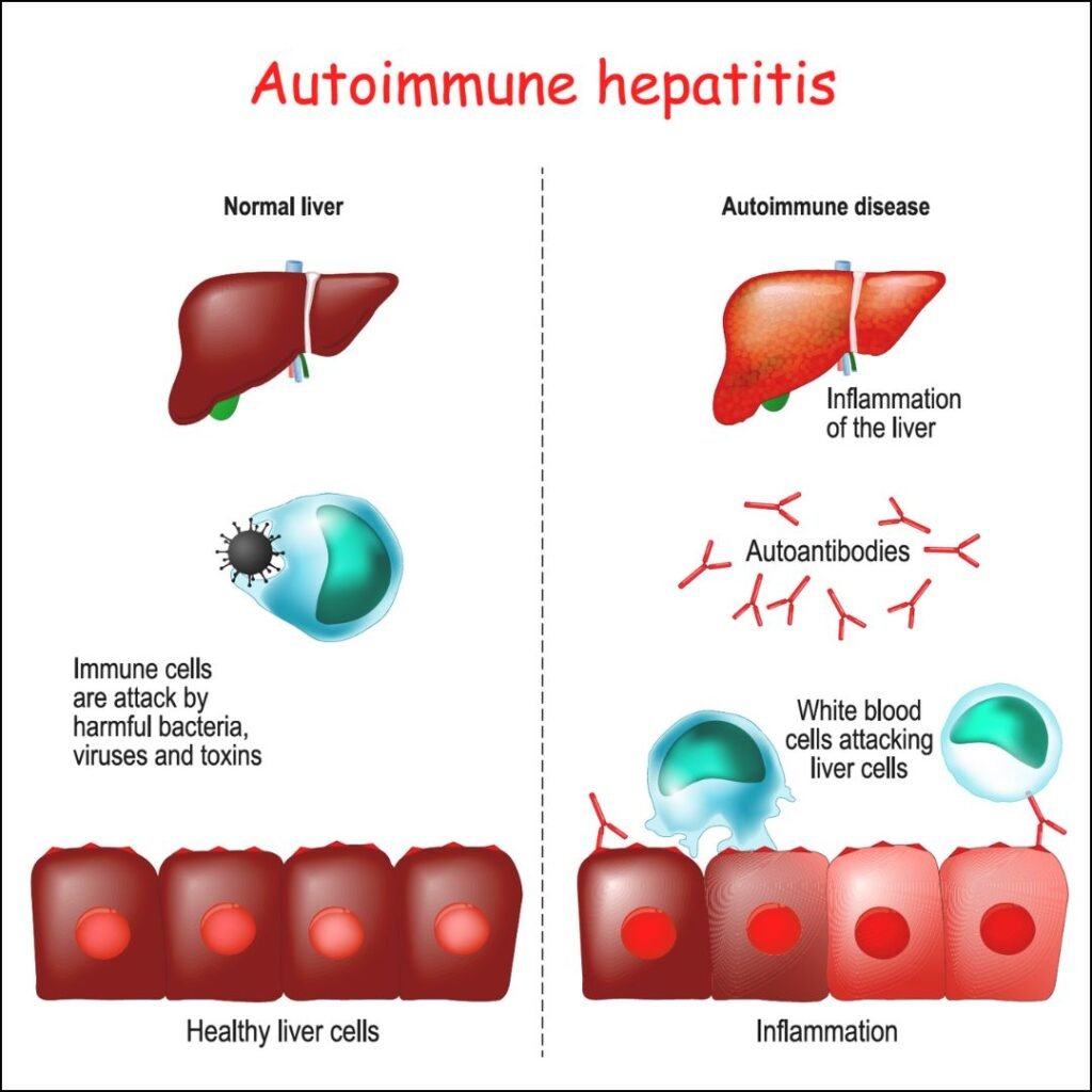 Autoimmune hepatitis