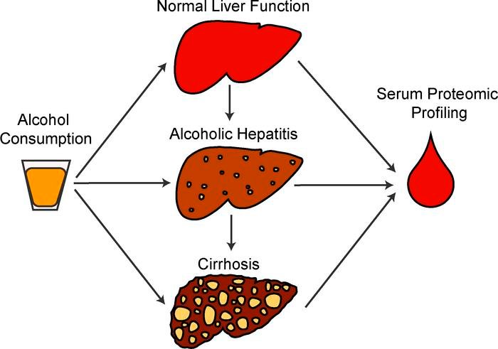 alcoholic-hepatitis